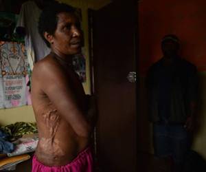 Una mujer que sobrevivió a un ataque, tras ser acusada de hacer brujería, muestra las cicatrices de las agresiones. (Foto: AFP)