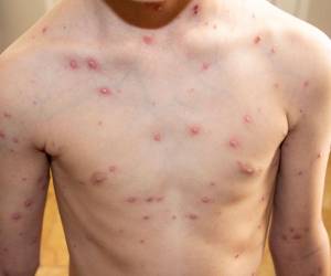 Las personas que se infectan con la viruela del mono sufren de una erupción en la piel, ampollas rojizas que se llenan de pus.