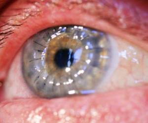 La paciente usó mensualmente lentes de contacto desechables durante 35 años. Foto: Wikimedia Commons