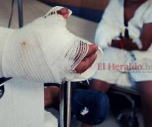 En el Hospital Escuela (HE) de Tegucigalpa dos personas fueron atendidas con quemaduras por pólvora en la emergencia durante la Nochebuena.