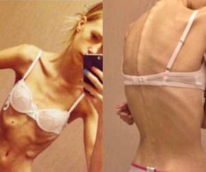 Cazandra ya no podía más con la anorexia que día a día tenía más efectos negativos en su cuerpo. Fotos Instagram @cazandrazetterberg