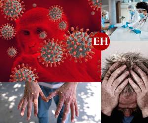 Ambos virus han sido declarados como emergencias sanitarias por la Organización Mundial de la Salud (OMS) y aunque sus síntomas son muy parecidos, hay diferencias entre la viruela del mono y el covid-19. En esta galería te despejamos algunas dudas que han surgido en las últimas semanas.