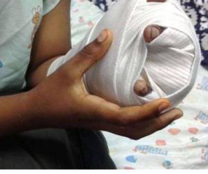 Un niño de cinco años perdió su mano el fin de semana tras manipular un cuete; el menor fue ingresado a Fundaniquem.