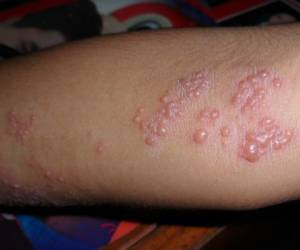 El herpes zóster, causado por el virus de la varicela, aparece en forma de erupción cutánea sobre la terminación de los nervios y puede provocar fuertes dolores. Foto: Wikimedia Commons