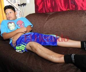 El pequeño Joan se ha tenido que someter a 13 cirugías para corregir su pierna derecha. Fotos: Alejandro Amador/EL HERALDO