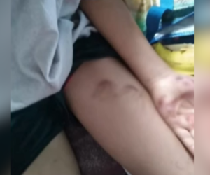 Imagen de las marcas que le dejaba su madre al menor; presentaba cortadas y mordidas en su brazo y pierna.