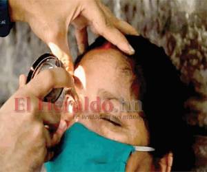 Los médicos creen que la mucormicosis puede estar provocada por el uso de esteroides, unos compuestos farmacológicos usados para los tratamientos de pacientes graves o en estado crítico por covid-19.