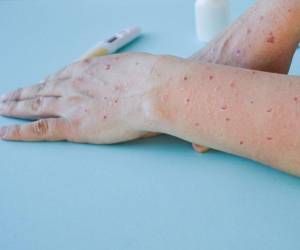 La OMS activó su máximo nivel de alerta por la viruela del mono.