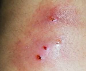 La mosca deja sus huevecillos en heridas expuestas, cuando se convierten en larvas se comen el tejido vivo de las personas.
