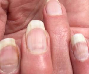 Si tus uñas lucen así es probable que sea a causa del covid-19.