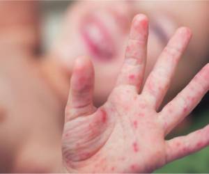 El coxsackie es el causante de llagas y sarpullido precisamente en manos, pies y la boca.