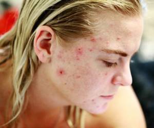 El acné es una enfermedad inflamatoria crónica de la piel que afecta al 90% de los adolescentes y al 40% de la población adulta sobre todo mujeres.