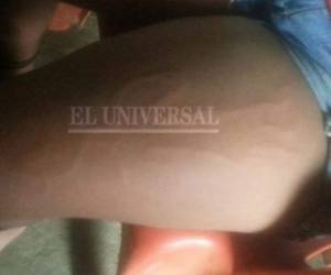 Foto de la supuesta figura de una muñeca en la pierna de la niña. Foto: Cortesía El Universal de Colombia.