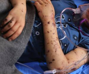 Layan al-Baz, amputado de trece años, recibe tratamiento en el hospital Nasser de Khan Yunis, en el sur de la Franja de Gaza.