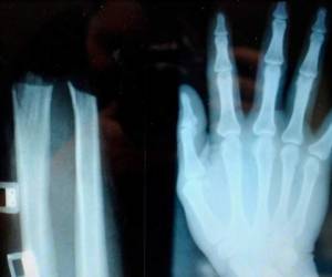 La mano fue recuperada a tiempo y cosida en un hospital de Liubliana.