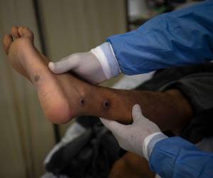 Los expertos aseguran que “el manejo de los desechos es fundamental” para reducir el riesgo de contaminación a roedores y otros animales salvajes.