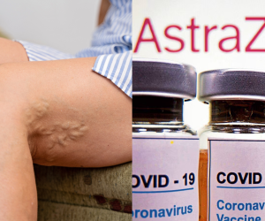 Estos son los algunos de los efecto secundario que pueden tener algunas personas que se vacunaron con la AstraZeneca.