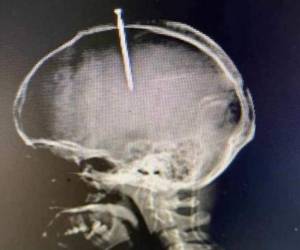 Esta fue la radiografía de Natanael García Polanco, de 33 años, quien dijo sentir el 'cerebro flojo'.