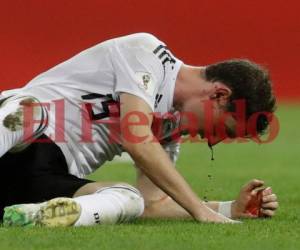 Sebastian Rudy fue victima de una fuerte patada en su rostro. Foto AP