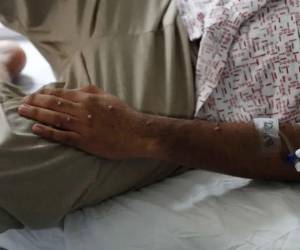 El Ministerio de Salud recomendó evitar el contacto físico estrecho, con personas que presenten lesiones compatibles con la enfermedad o que tengan un diagnóstico confirmado.