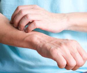 Cuando padece este trastorno su piel está desprotegida ante las bacterias, irritantes y alérgenos.