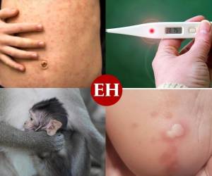 Después de Reino Unido, España y Portugal anunciaron este miércoles que también han identificado casos de viruela del mono, una enfermedad rara en Europa, de ellos cinco confirmados y más de una veintena sospechosos. ¿Cómo se contagia y cuáles son sus síntomas? Aquí te contamos.