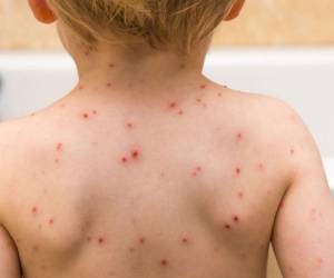 Expertos recomiendan a la población realizar la vacunación contra el sarampión en menores, población que se proyecta como la más vulnerable ante la viral enfermedad.