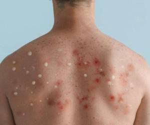 En Centroamérica se han detectado casos de manera oficial en Costa Rica, Guatemala y ahora Honduras.