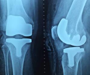 Nuevo sistemas para reducir el rechazo del cuerpo hacia las protesis, El nuevo tratamiento se denomina Silanización por Vapor Activado (AVS). Foto:Cortesia de Pixabay