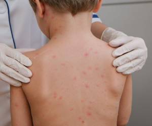 La Secretaría de Salud confirmó cuatro casos de sarampión en una familia de Cofradía, San Pedro Sula, y reforzó la vacunación para contener la propagación del virus.