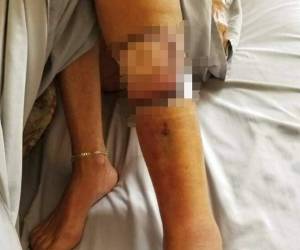 Lynn Fleming falleció después de que una niña de 12 años se raspó un dedo del pie y contrajo la misma bacteria el mes pasado durante unas vacaciones en el extremo noroccidental de Florida. Foto: AP.
