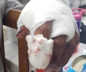 Uno de los niños perdió tres de sus dedos tras el estallido de un cohete en sus manos. Foto ilustrativa.