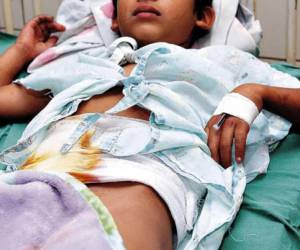 Durante las festividades de Navidad se reportaron cinco menores con quemaduras por manipulación de pólvora.