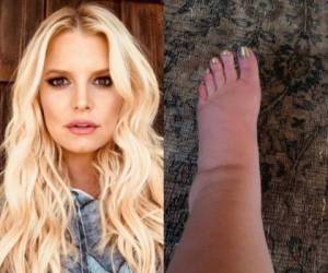 En esta composición se muestra lo hinchado que esta el pie derecho de actriz Jessica Simpson.