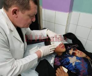 Uno de los menores sufrió quemaduras en su rostro a causa de un volcán.