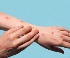 Esta medida permite a las autoridades movilizar personal, reducir trámites burocráticos y desplazar recursos para superar una crisis de salud pública que recuerda al tiempo en el que la epidemia del sida devastó la ciudad.