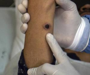 El paciente no se encuentra hospitalizado debido a que presenta síntomas leves y se le brindó tratamiento médico.