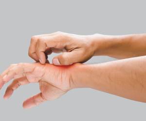 El país sigue a la espera de los resultados que determinarán si se trata del primer caso confirmado de viruela del mono en Honduras.