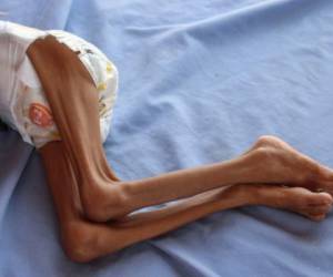 Un niño yemení que sufre desnutrición yace en una cama de un hospital del distrito norte de Abs. Foto AFP