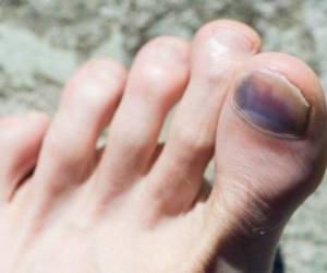 En muchos casos la uña negra del pie se curará sin tratamiento, pero si no se le da el cuidado adecuado puede llegar a desprenderse totalmente de la piel. Foto: Cuidate Plus