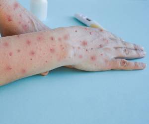 Hasta el momento ningún caso se registra en el Distrito Central.