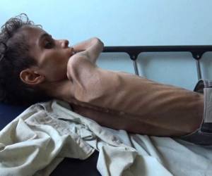 Ghazi Saleh, de 10 años y apenas ocho kilos de peso, respira con dificultad en una cama de hospital en Taez, una ciudad del suroeste de Yemen. (Foto: AFP)