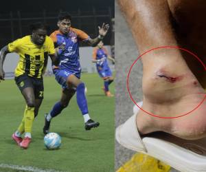UPNFM hace fuerte denuncia luego de que uno de sus futbolistas saliera herido tras el juego ante Real España en el Morazán.