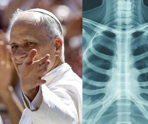 De forma sorpresiva, tras el rezo del Ángelus, el papa León XIV anunció que deberá someterse a una cirugía por un nódulo en uno de sus pulmones. ¿En qué consiste este diagnóstico y qué se sabe sobre este tipo de lesiones?
