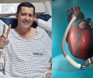 ¿Qué es el corazón artificial de L10.5 millones que necesita diputado de Libre para vivir? El congresista Octavio Morales requiere de un artefacto para salir adelante, algo que es sumamente caro.