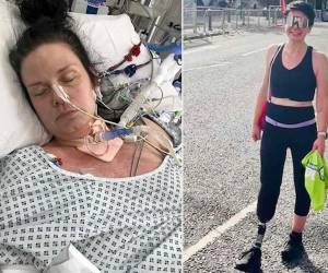 Como consecuencia de la enfermedad, la mujer también quedó con una función pulmonar y renal reducida.