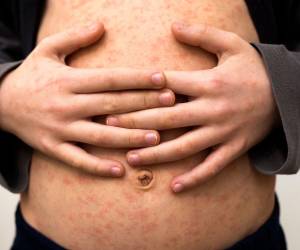 Las edades de las personas sospechosas de sarampión rondan 14, 32, 22 y 6 meses.