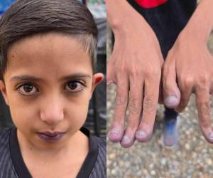 Josué Nehemías Cruz Cruz, un niño hondureño de 11 años, recibirá atención médica especializada en El Salvador luego de que su caso llegara hasta las autoridades de ese país tras una extraña condición. Aquí le explicamos su caso: