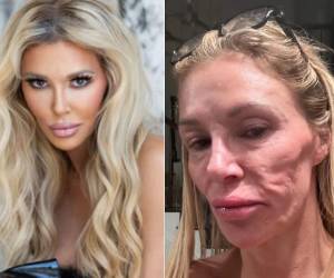 La exparticipante de The Real Housewives of Beverly Hills confirmó que recibió un diagnóstico oficial para la condición que ha afectado su rostro desde 2023, aunque no reveló de qué se trata.