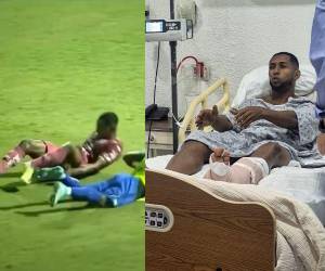Romario da Silva, futbolista de Motagua, fue operado luego de la espantosa lesión que sufrió la noche del 12 de mayo ante Potros de Olancho. ¿Volverá a jugar profesionalmente? Esto es lo que se sabe.